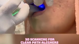 3D SCANNING FOR CLEAR PATH ALIGNERS [upl. by Coheman433]