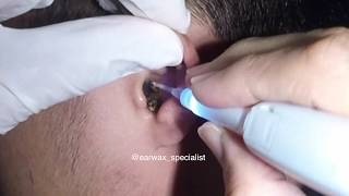 Mans MASSIVE Earwax Softened and Removed with Hydrogen Peroxide [upl. by Imeon]