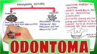 Odontoma  Types Clinical features Histopathological Features amp Treatment [upl. by Nerhtak687]