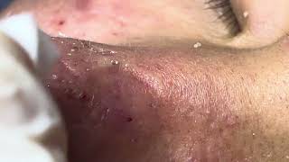 Acne treatment Thu 90 Da Nang  new 112024 [upl. by Llertac]