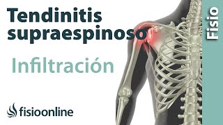 Tendinitis de hombro o supraespinoso infiltraciones [upl. by Babbie231]