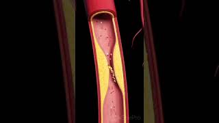 Composition Of Bad Cholesterol HypertensionAtherosclerosis NursingGyanshortsreels ytshorts [upl. by Yodlem]