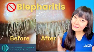 Best Blepharitis Treatments at Home  Simple amp Effective  Step by Step Guide Eye Surgeon Explains [upl. by Lienad]