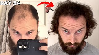 BALDING HAIR GROWTH For 15 Years  Reviewed [upl. by Bethany845]