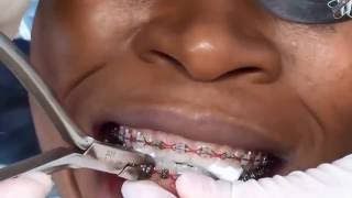 removing braces orthodontic [upl. by Ennagem]