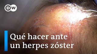 Primero varicela luego herpes zóster [upl. by Plato65]