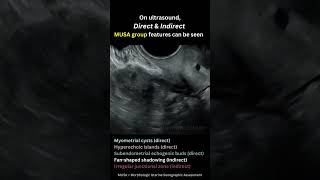 Ultrasound vs Surgical Diagnosis of Adenomyosis ultrasound adenomyosis laparoscopy [upl. by Yentihw]