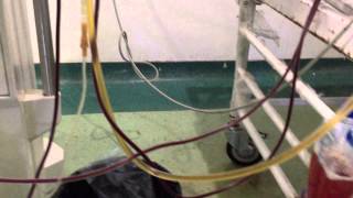 Plasmapheresis in Renal transplant with severe AMR Dr Sandeep kumar garg [upl. by Rayna]