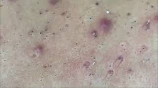 Back Treatment  Blackhead extractions [upl. by Maitilde]