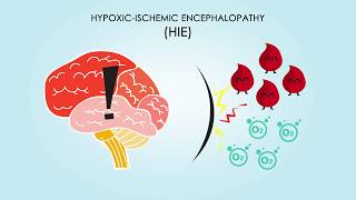 HypoxicIschemic Encephalopathy About Treatments amp Causes [upl. by Haneekas146]