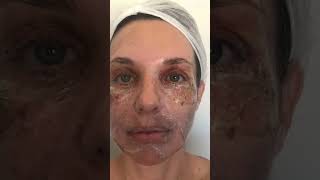 Peeling de fenol  evolução 14 dias fenol peelingdefenol dermatologia personadermatologia [upl. by Mcadams]