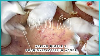 Big Cystic Acne Blackheads Extraction Blackheads amp Milia Whiteheads Removal Pimple Popping [upl. by Worl]