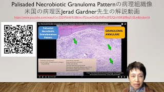 Palisaded necrobiotic granuloma patternの病理組織像の解説動画 [upl. by Hake231]