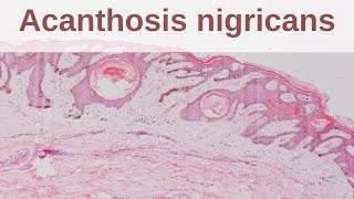 Acanthosis Nigricans  Pathology mini tutorial [upl. by Carlile]