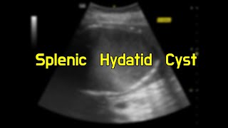 Splenic Hydatid Cyst [upl. by Attena]