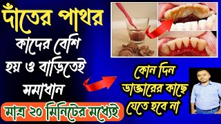 দাঁতের পাথর দূর করার উপায়  how to remove dental tartar  teeth calculas remove Solution💯 [upl. by Letniuq]