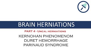 BRAIN HERNIATIONS 44 Uncal herniationDuret Hemorrhage Kernohan Phenomenom amp Parinaud Syndrome [upl. by Taro]