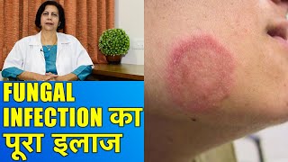 फंगल इन्फेक्शन का पूरा इलाज  Complete Treatment of Fungal Infections [upl. by Yzmar]