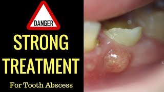 Cure Tooth Abscess Naturally In Record Time With This 1 Basic Technique [upl. by Cissiee929]