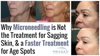 Why Microneedling Does Not Lift Sagging Skin or Treat Age Spots and Treatments for Both Issues [upl. by Bajaj]