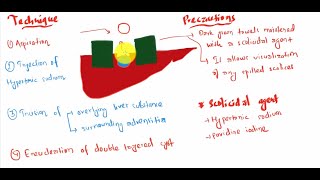 Hydatid disease of liver [upl. by Eva]