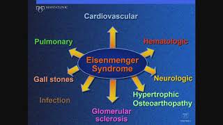 Adult Congenital Heart Disease Eisenmenger Syndrome [upl. by Alejandrina417]