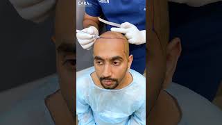 Discover Cara Clinics AFFORDABLE Hair Transplant Solutions in India [upl. by Hannasus]