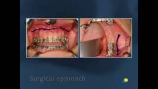 Fixation of a Transverse Fracture of the Mandibular Angle [upl. by Archie]