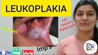 LEUKOPLAKIA  PREMALIGNANT LESION [upl. by Daub]