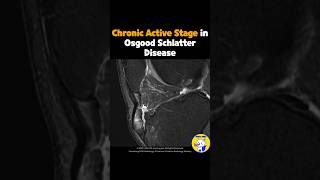 Fig 4B18 Osgood Schlatter Disease Chronic Active Stage [upl. by Joey757]