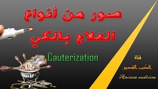 الكي  صور من أنواع العلاج بالكي  Cauterization [upl. by Bj]