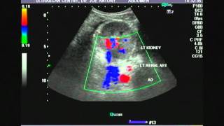 Left renal artery color doppler video [upl. by Furlani]