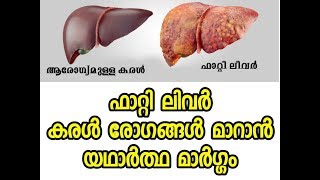 ഫാറ്റി ലിവര്‍ മാറ്റാം  Fatty Liver Home Remedy  Malayalam Health Tips [upl. by Aranat591]