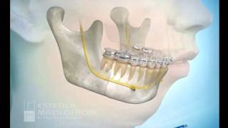 Avance Mandibular con Genoplastía [upl. by Naletak655]