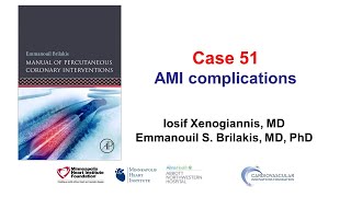 Case 51 PCI Manual  MI complications [upl. by Aslehc]