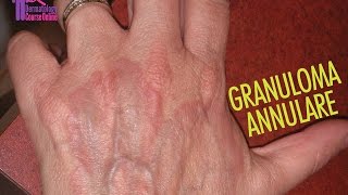 Granuloma Annulare كورس الجلدية الأون لاين [upl. by Hodgson]