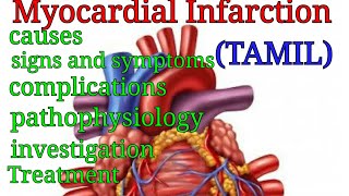 Myocardial infarction in Tamil class medics [upl. by Ahsiya]