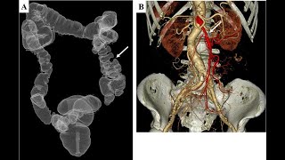 Colonography CT scan [upl. by Artenahs]