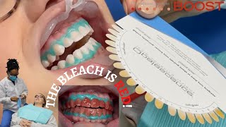 Professional TeethWhitening  Opalescence Boost StepbyStep with results [upl. by Aim759]