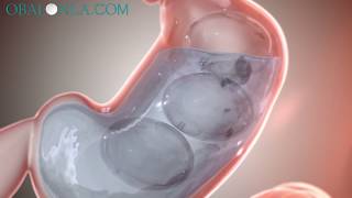 Obalon Gastric Balloon Los Angeles 2020Dr David DavtyanBeverly Hills GlendaleRancho Cucamonga [upl. by Samoht]