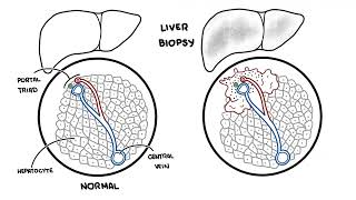 Autoimmune Hepatitis [upl. by Cathee]