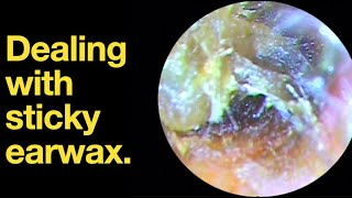 Dealing with sticky earwax ear wax removal  ear cleaning  ASMR  relaxation  relax [upl. by Annehcu]