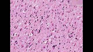 Histopathology BrainAstrocytoma [upl. by Hgielrak653]