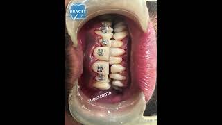 Class 2 div 1 Malocclusion  BRACES trending dentist toothdental dentalcare dentalclinic tooth [upl. by Atener]