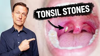 What CAUSES Tonsil Stones and How to Prevent Them [upl. by Akienom]