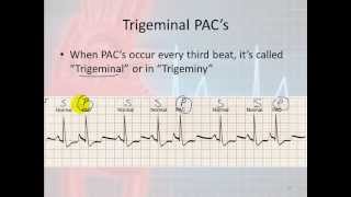 Basic Electrophysiology part 7  Atrial Rhythms part 1 Introduction and PACs [upl. by Tedder344]