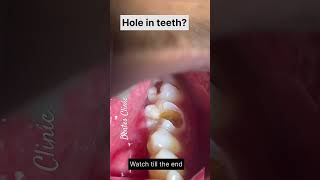 Dentist Teeth Filling Video Teeth Cavity teethcare [upl. by Ailemak]