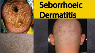 Seborrhoeic dermatitis  Explained under 3 minutes Seborrheic dermatitis Symptoms and treatment [upl. by Ashford688]