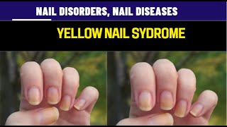 yellow nails syndrome Onychogryphosis [upl. by Carilla]