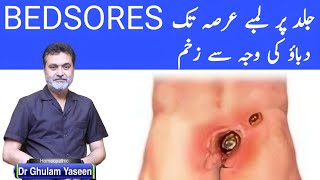 BEDSORES PRESSURE ULCERS زیادہ دیر تک دباؤ کی وجہ سے ھونے والے زخم [upl. by Fulton]